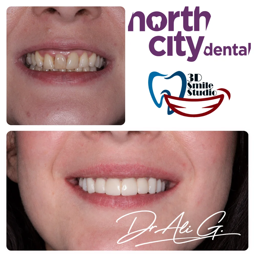 Composite bonding smile transformation completed at North City Dental