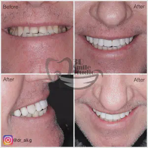 Smile Case