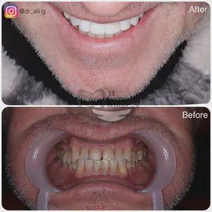 Smile Case