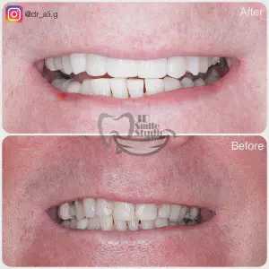 Smile Case