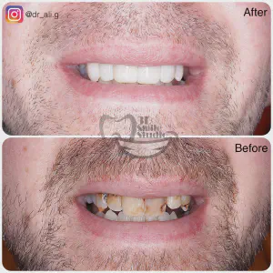 Smile Case