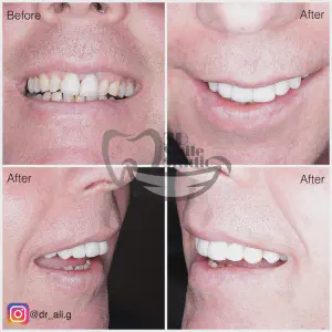 Smile Case