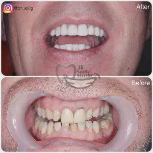 Smile Case