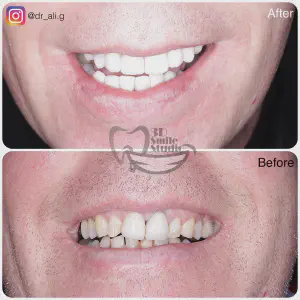 Smile Case
