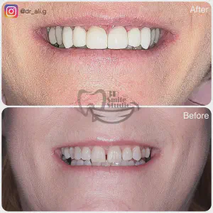 Smile Case