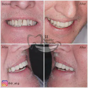 Smile Case