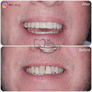 Smile Case