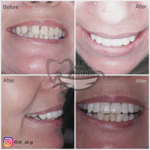 Smile Case