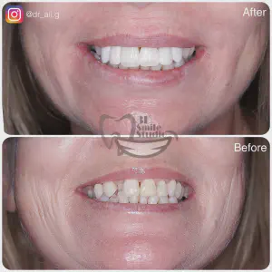 Smile Case
