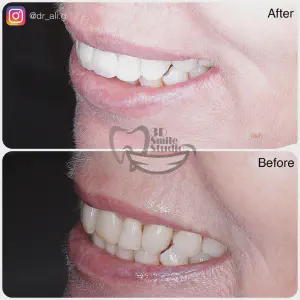 Smile Case