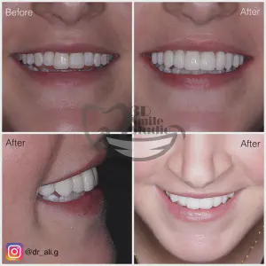 Smile Case