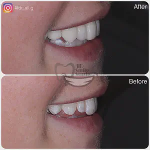 Smile Case