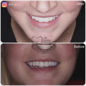 Smile Case