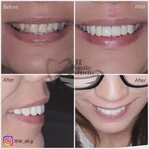 Smile Case