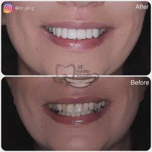 Smile Case