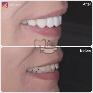 Smile Case