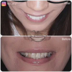 Smile Case