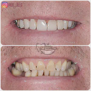 Smile Case