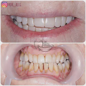 Smile Case