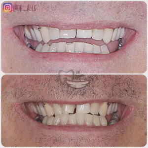 Smile Case