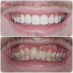 Smile Case