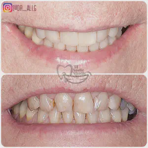 Smile Case