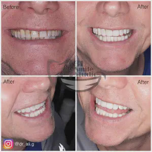 Smile Case