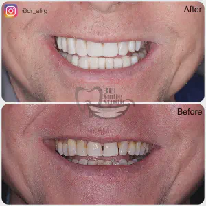 Smile Case