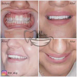 Smile Case