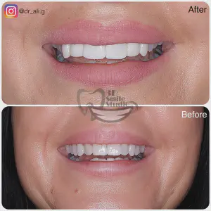 Smile Case