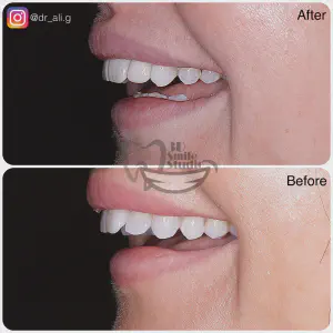 Smile Case