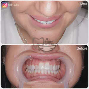 Smile Case