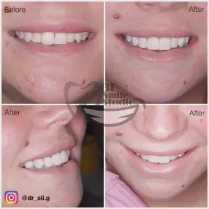 Smile Case