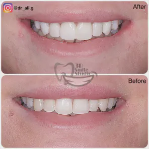 Smile Case