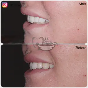 Smile Case