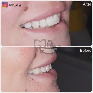 Smile Case