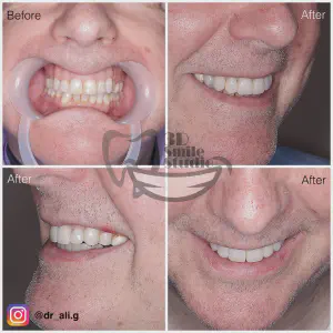 Smile Case