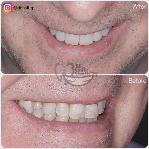 Smile Case