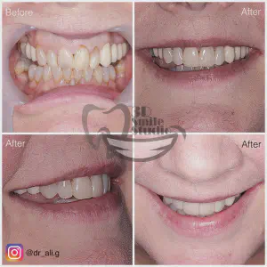 Smile Case