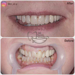 Smile Case