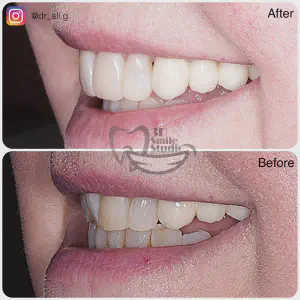Smile Case