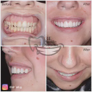 Smile Case