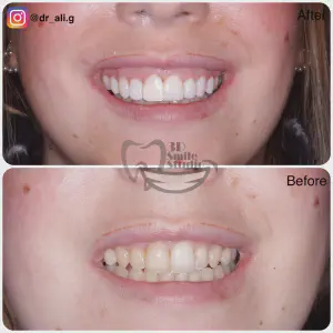 Smile Case