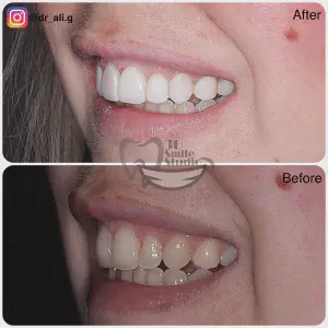 Smile Case