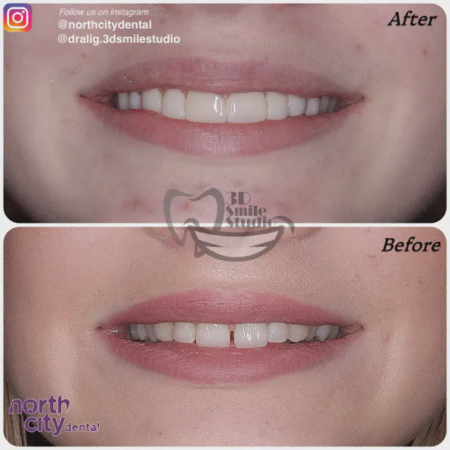 Front view of the upper front teeth before and after composite bonding