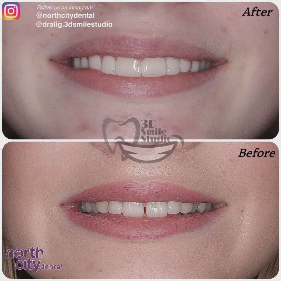 Smile makeover before and after case 1078 – composite bonding Dublin