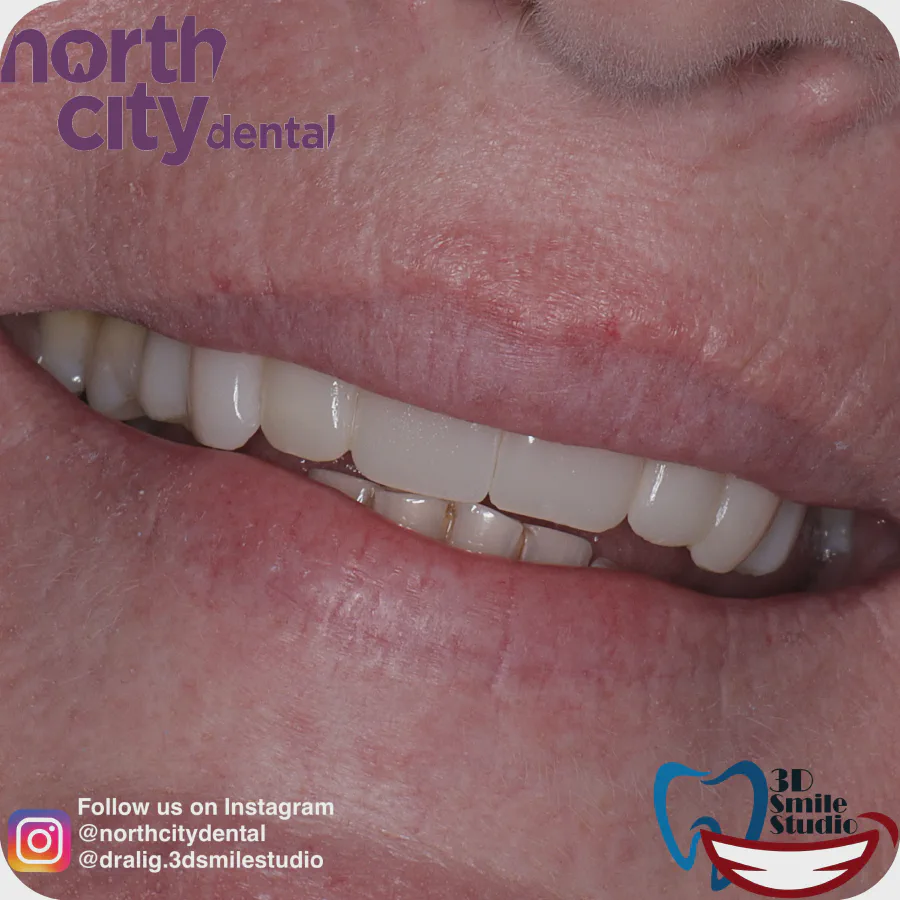 Smile makeover before and after case 1068 – composite bonding Dublin