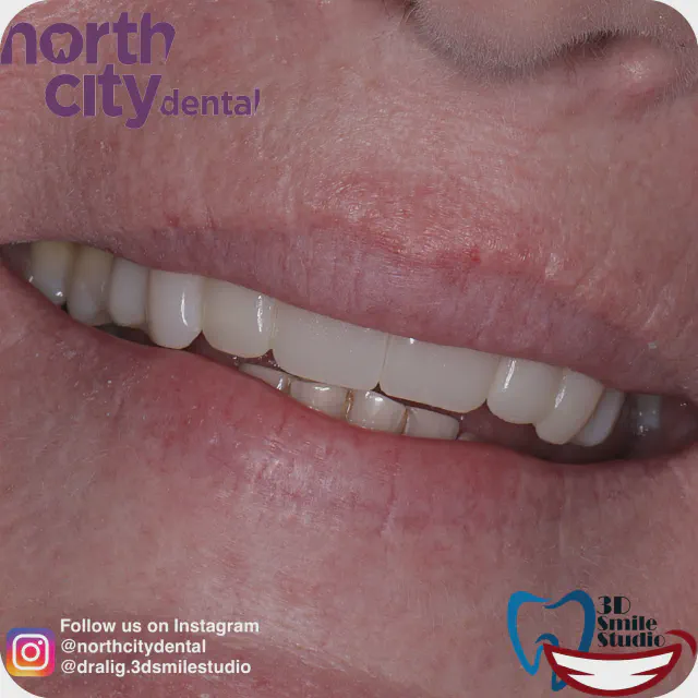 Front smile view before and after composite bonding for dental spacing