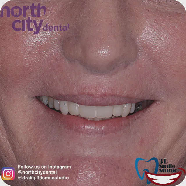 Closer front view before and after composite bonding to improve tooth proportions