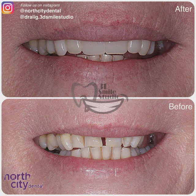 Close-up view of composite bonding around the upper front teeth
